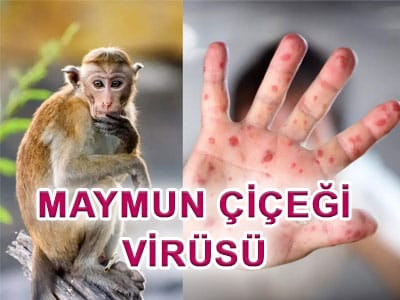 Maymun Çiçeği Virüsü Nedir